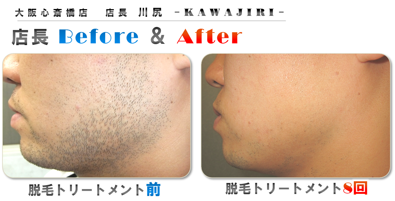 メンズ脱毛サロンゼロ心斎橋店長紹介