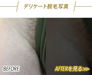 VIO脱毛before after
