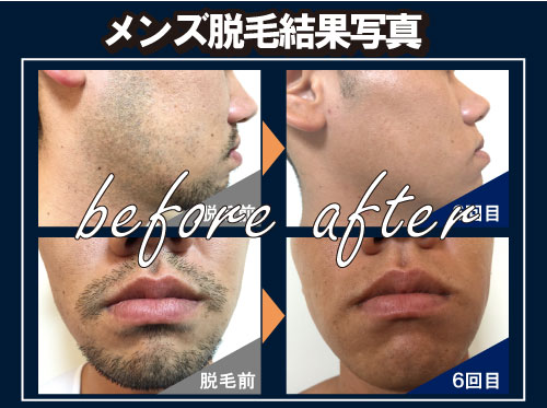 メンズ脱毛ZERO結果写真「ビフォーアフター」
