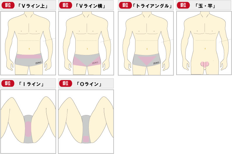 京都メンズ脱毛 キャンペーン第2弾男のVIO脱毛、陰部全6部位